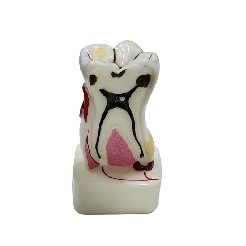 UM-AA1 Anatomic Profile Model of the Mandibular Molar(6 Times the Natural Size)