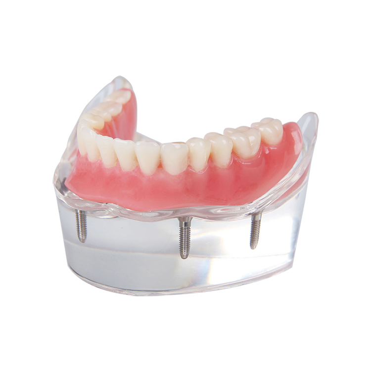 UM-6003 Overdenture Model with 4 Implants