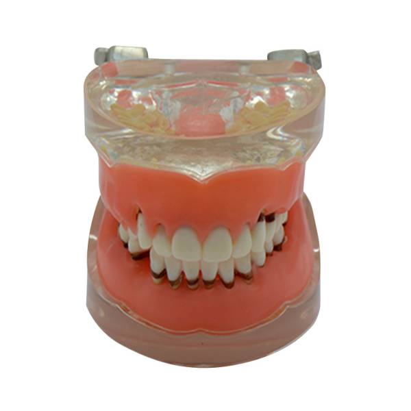 UM-S9 Gingival Disease Model