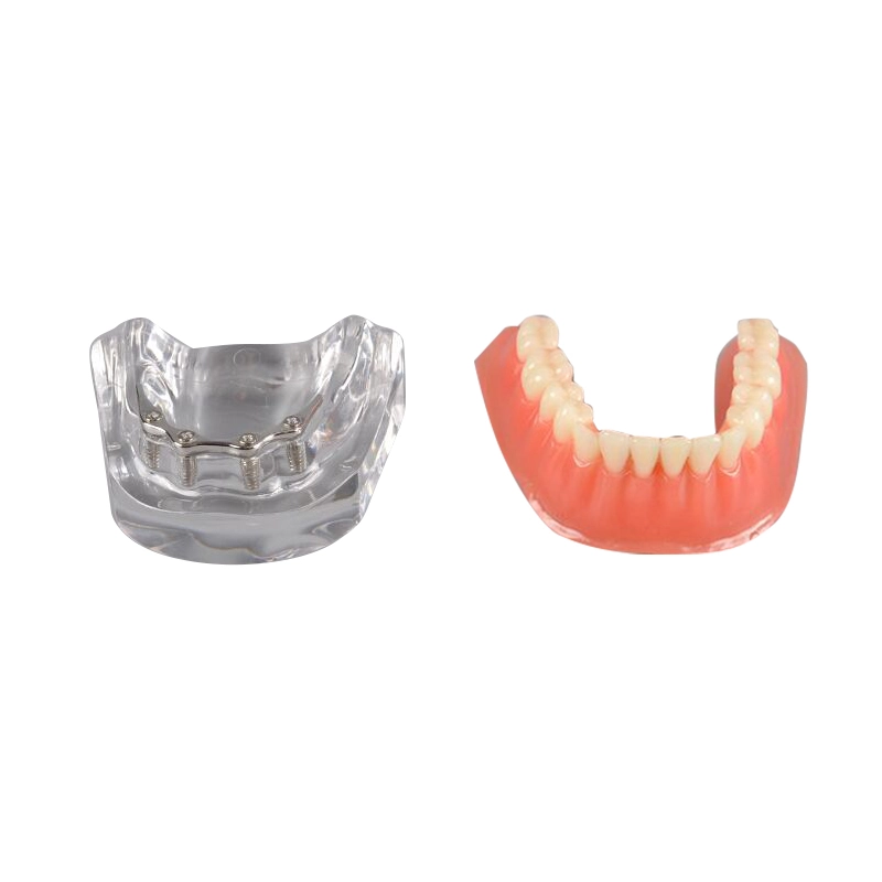 UM-6008 Implant Practice Jaw Model